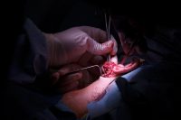 Cirugía glándula parótida